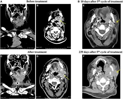 Squamous Cell Carcinomas of the Head and Neck Cancer Response to Programmed Cell Death Protein-1 Targeting and Differential Expression of Immunological Markers: A Case Report